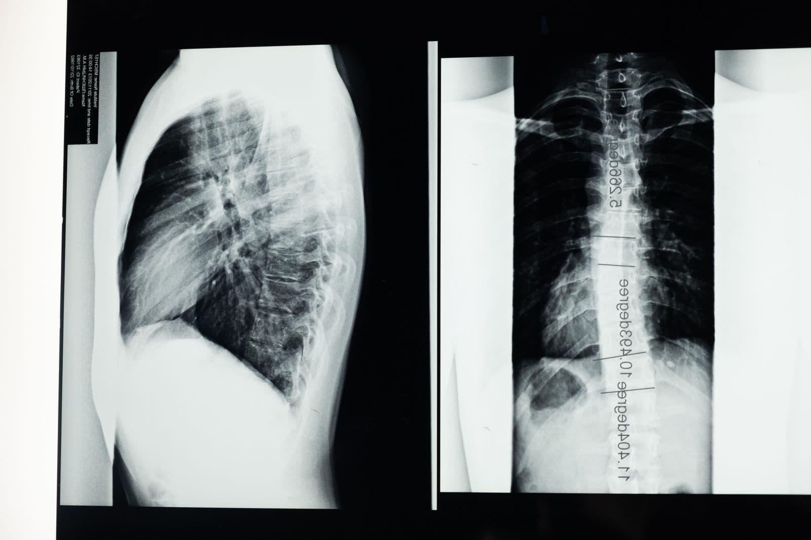 Two spinal X-ray films on a lightbox, a side view and a back view with measurement lines drawn along the spine